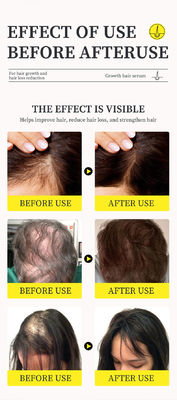 Potente suero para el tratamiento de la pérdida de cabello con aceite de jengibre y vitamina B5